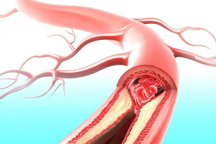 Как стресс закупоривает артерии