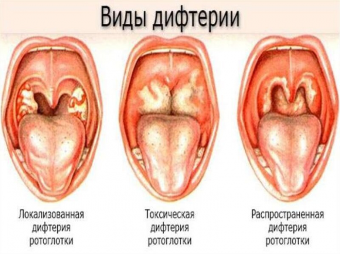 Братство, объединенное шрамами: от каких болезней делают прививки