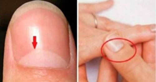 13 проблем со здоровьем, о которых предупреждают лунки на ногтях.