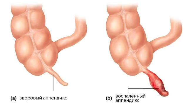 Первые симптомы и признаки аппендицита