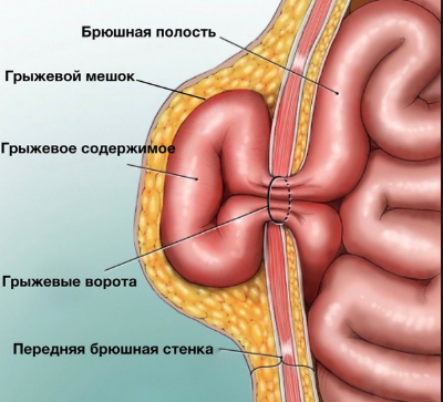 Почему появляются грыжи и чем они опасны?