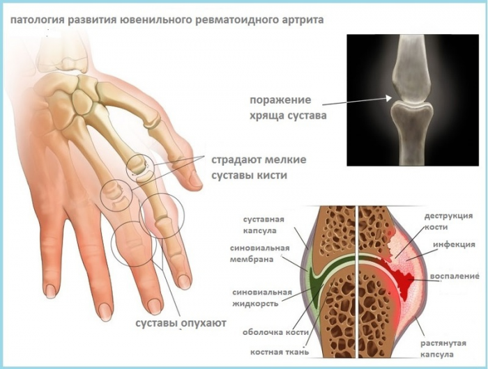 О чем говорит боль в суставах