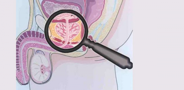 Аденома простаты: проблема, которая решается