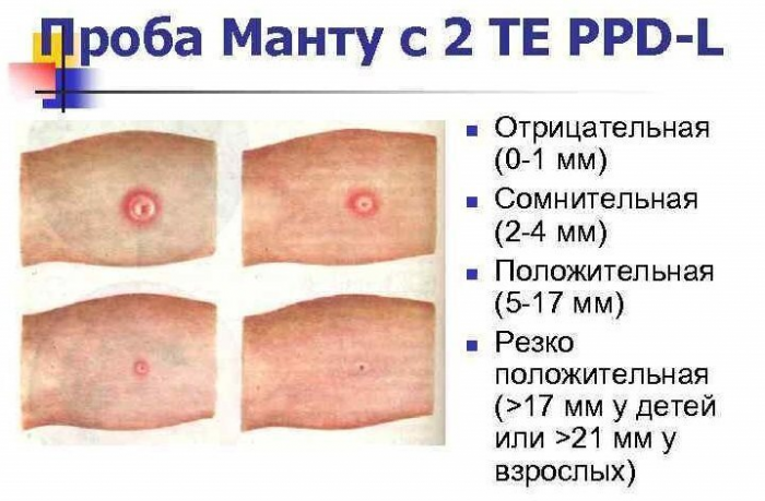 Братство, объединенное шрамами: от каких болезней делают прививки