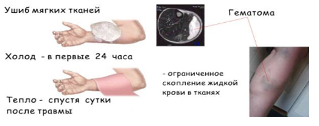 Отчего появляются синяки на теле: причины, симптомы, оказание первой помощи